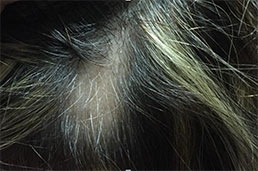 - Problemas más frecuentes del cuero cabelludo