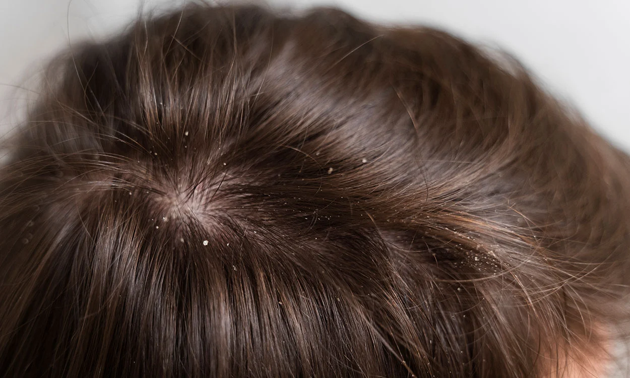 Tratamiento para mejorar la densidad del cabello Tratamiento para mejorar la densidad del cabello