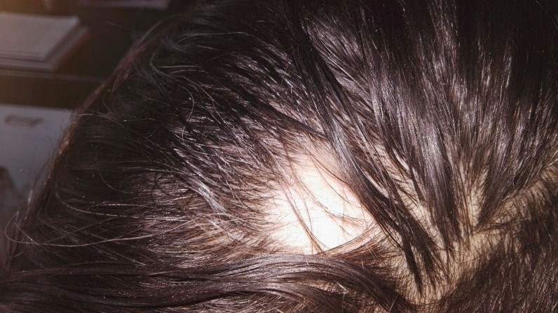 Ejemplo de Dermatitis seborreica en caballero Ejemplo de Dermatitis seborreica en caballero