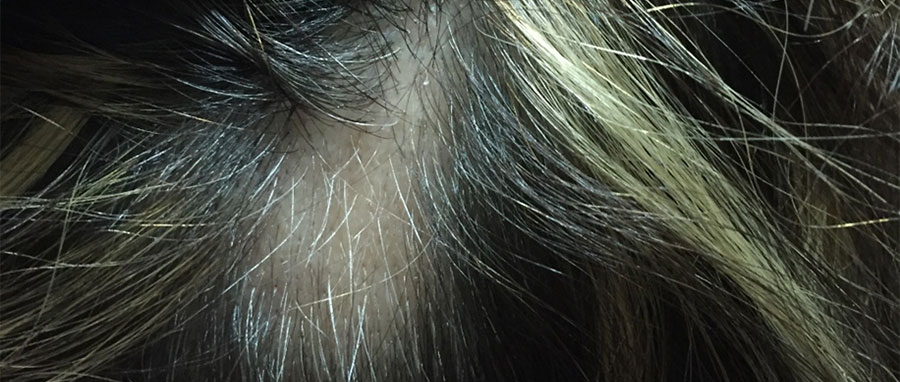 Ejemplo de Alopecia areata en cabello de señora