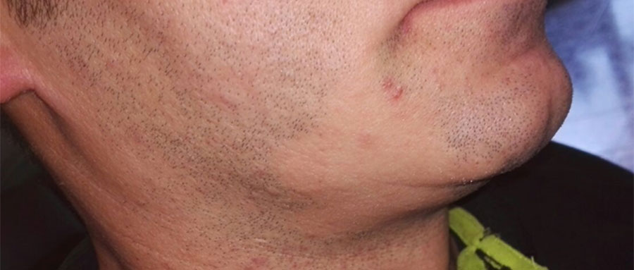 Ejemplo de Alopecia areata en barba de caballero