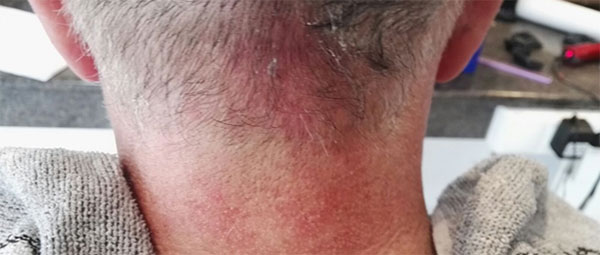 Dermatitis seborreica del cuero cabelludo - BySimone
