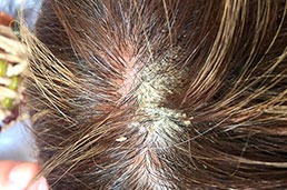 Las alteraciones más comunes del cuero cabelludo