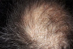 Cómo distinguir entre los diferentes tipos de alopecia
